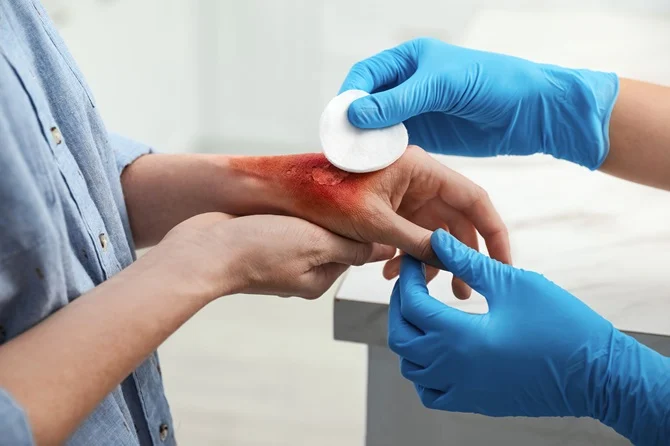 Burn Injury